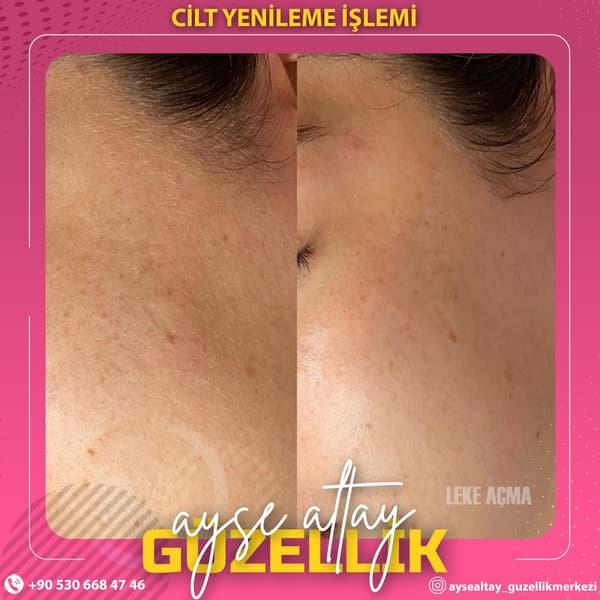Ayşe Altay Güzellik Merkezi - 72. Fotoğraf