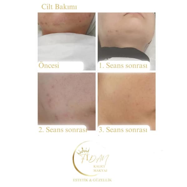 Fidan Kalıcı Makyaj Estetik Güzellik - 11. Fotoğraf Fidan Kalıcı Makyaj Estetik Güzellik - 11. Fotoğraf