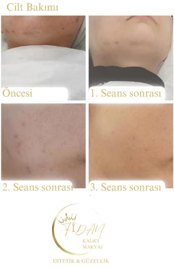 Fidan Kalıcı Makyaj Estetik Güzellik - 14. Fotoğraf Fidan Kalıcı Makyaj Estetik Güzellik - 14. Fotoğraf