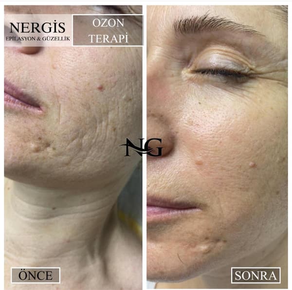 Nergis Epilasyon ve Güzellik - 14. Fotoğraf Nergis Epilasyon ve Güzellik - 14. Fotoğraf