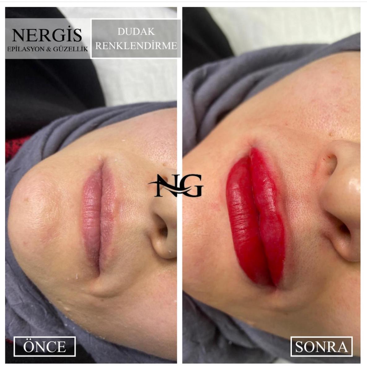 Nergis Epilasyon ve Güzellik - Mamak Hydragold (Yeni Nesil Cilt Bakımı) - 2. Fotoğraf