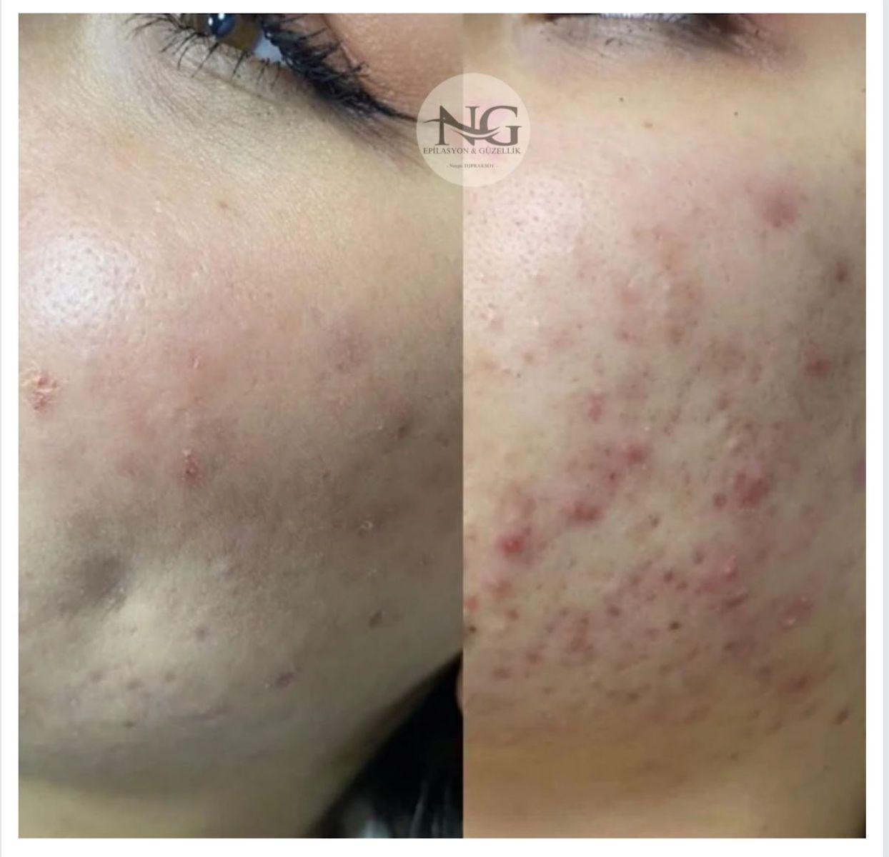 Nergis Epilasyon ve Güzellik - Mamak Hydragold (Yeni Nesil Cilt Bakımı) - 3. Fotoğraf